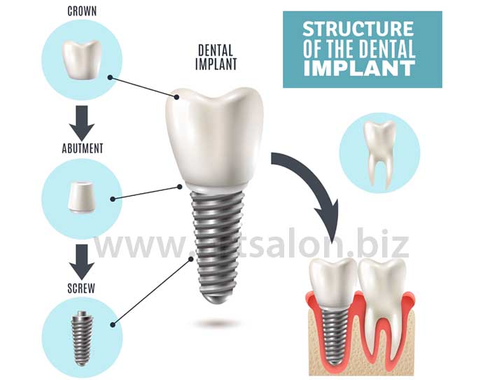 1_dental-implant