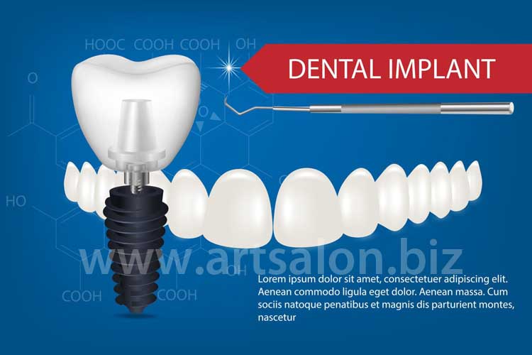3d-model-of-an-implant-with-thread