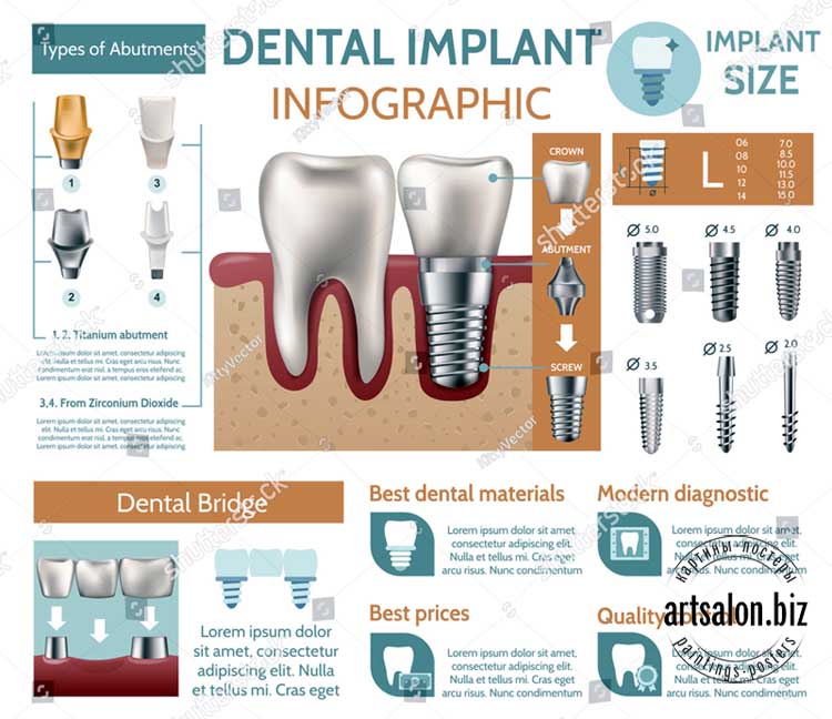 dental-implant-tooth-care-medical-center-dentist-clinic