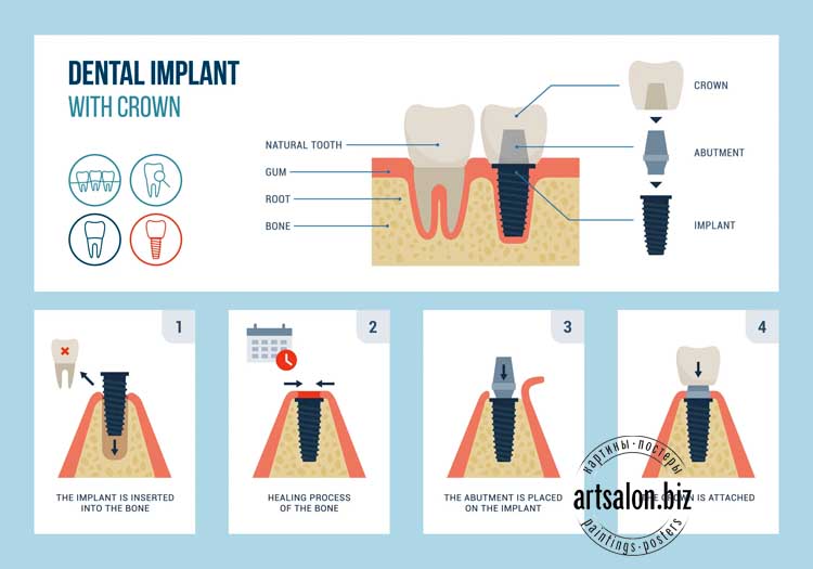 dental-implant1