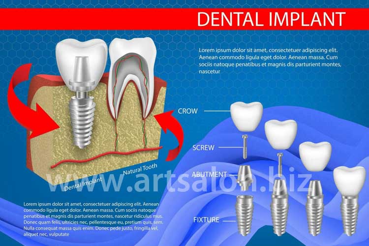 human-teeth-and-dental-implant