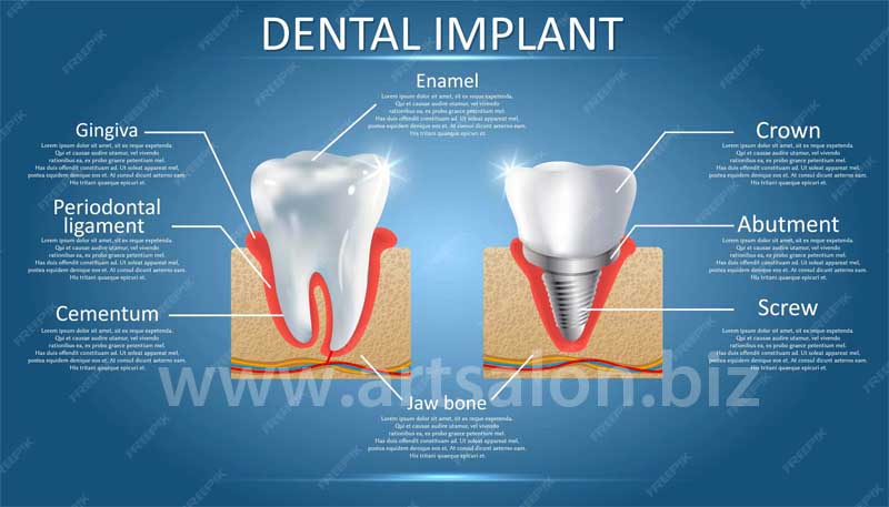 human-tooth-dental-implant-with-crown-attached-diagram